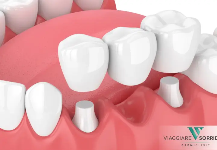 Dettaglio di una capsula devitalizzazione dente, con ponti dentali che coprono monconi preparati.