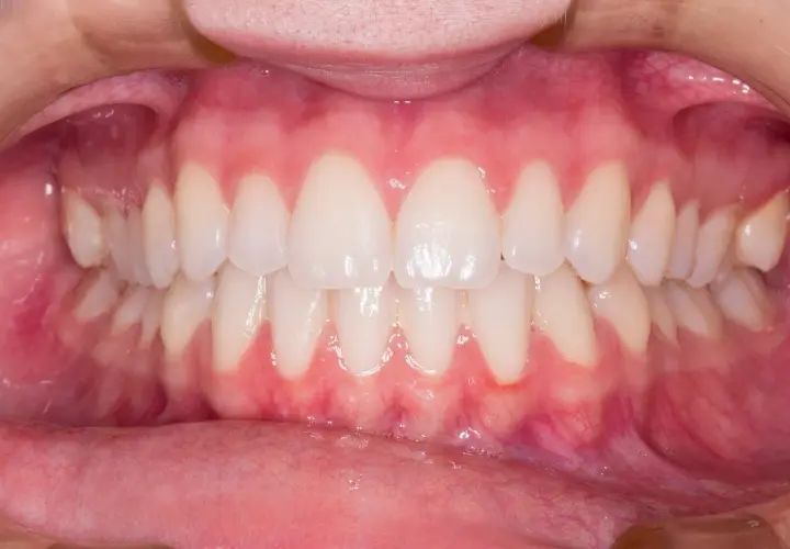 Gengive rosse e gonfie, con segni di sanguinamento gengive quando preoccuparsi. Denti bianchi e allineati.