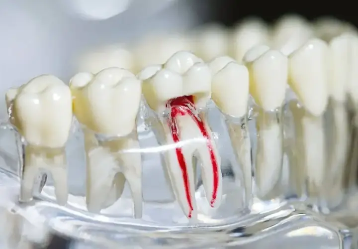Model zęba z widocznym uszkodzonym kanałem korzeniowym, ilustrujący potrzebę leczenia endodontycznego.