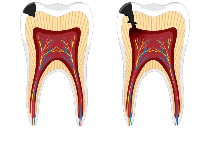 Secuencia de caries que avanza hacia la pulpa dental, mostrando la progresión de la pulpitis muela.