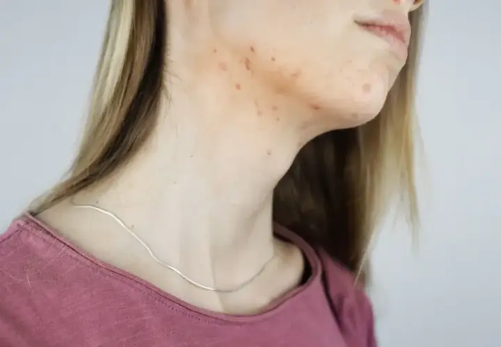 Pryszcze na szyi: Przyczyny, skuteczne sposoby i kiedy do dermatologa?