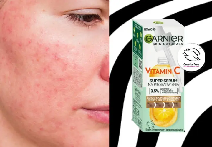 Skóra z zaczerwienieniami i niedoskonałościami. Obok opakowanie serum Garnier z witaminą C na przebarwienia, obiecujące efekty już po 6 dniach.