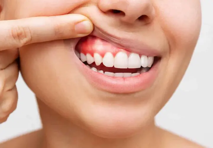 Dente con un piccolo puntino bianco sulla gengiva infiammata, evidenziato da un dito.