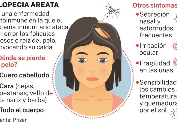 Ilustración de una mujer con alopecia areata, mostrando la pérdida de cabello en el cuero cabelludo y otros síntomas.