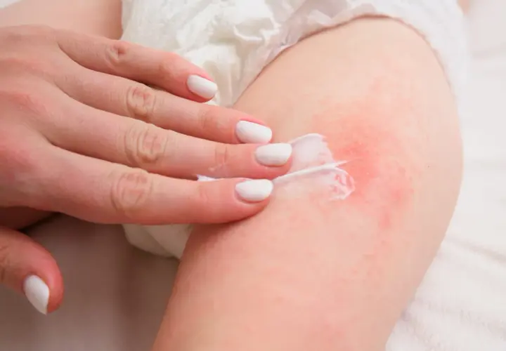 Mano applica crema su pelle arrossata, per la cura dell'intertrigine glutei.