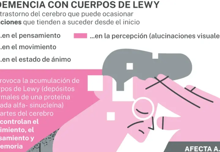 La demencia con cuerpos de Lewy afecta pensamiento, movimiento, ánimo y percepción. Se debe a depósitos de proteína alfa-sinucleína en el cerebro.