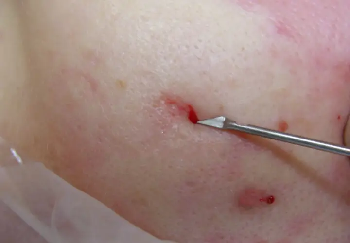 Närbild på hud där en subcision behandling utförs med ett vasst instrument som skär under ärr.