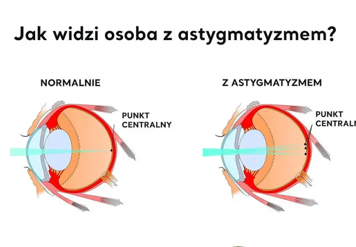 Jakie są wady wzroku? Poznaj objawy i skuteczne leczenie
