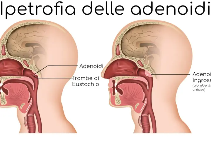 Confronto tra adenoidi normali e ingrossate che ostruiscono le trombe di Eustachio.