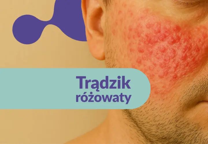 Trądzik różowaty na twarzy. Szukasz informacji o rozex krem opinie?