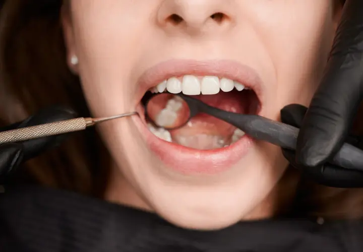 Zbliżenie na usta pacjentki podczas zabiegu ekstrakcji zęba. Dentysta w czarnej rękawiczce używa lusterka i narzędzia.