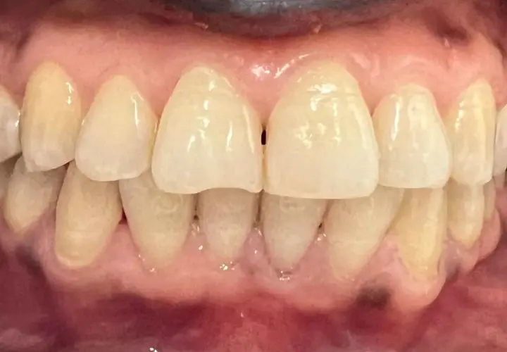 Primer plano de dientes y encías, mostrando algunas manchas oscuras en las encías.