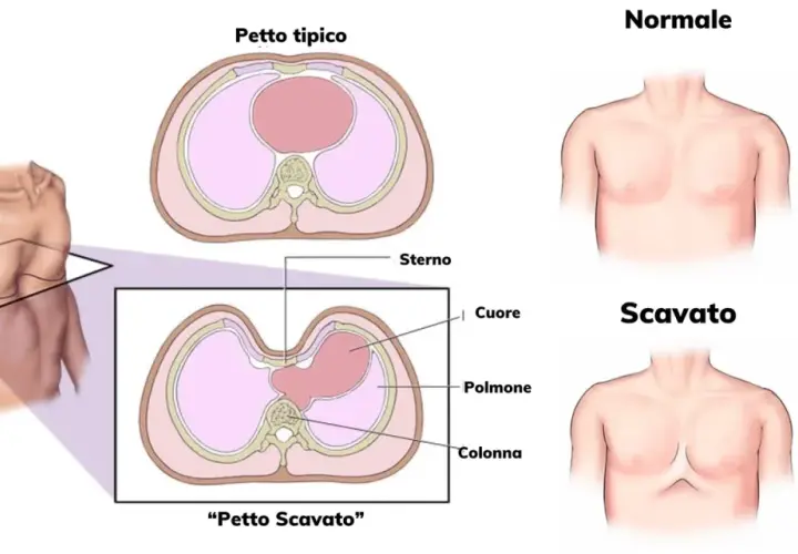 Confronto tra petto tipico e petto escavato nei bambini. Illustrazione anatomica mostra la forma del torace e la posizione degli organi interni.