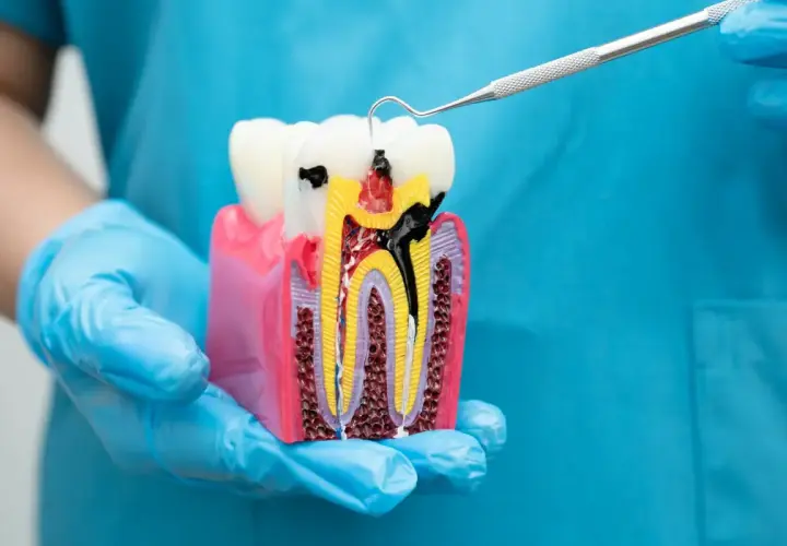 Model zęba z widocznym wypełnieniem kanałów korzeniowych gutaperką. Dentysta pokazuje, jak wygląda prawidłowe leczenie kanałowe.