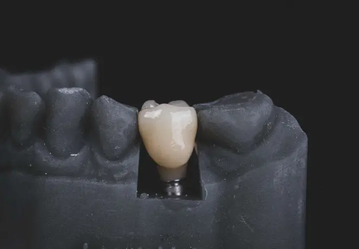 Modello di arcata inferiore con impianto dentale e corona in ceramica.