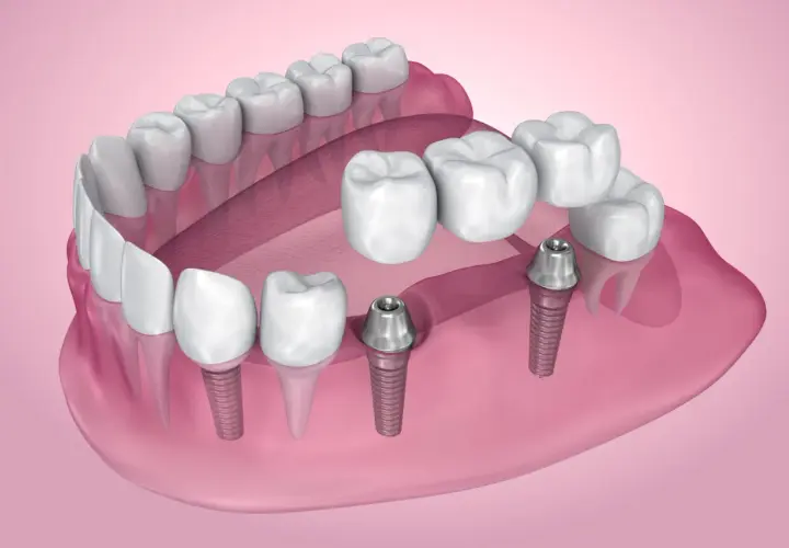 Nowoczesne mosty zębowe na implantach, przywracające pełny uśmiech.