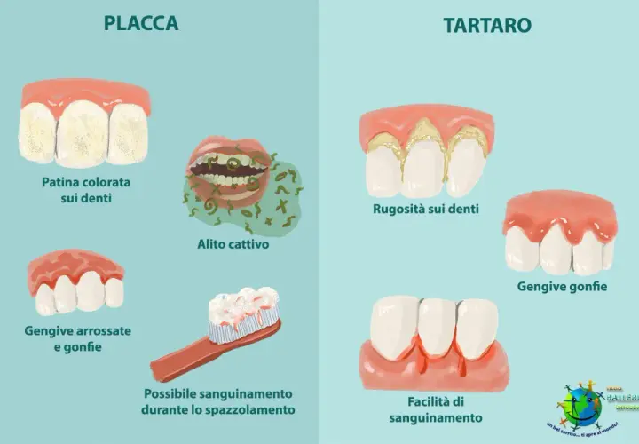 Illustrazione che mostra la differenza tra placca e tartaro: la placca causa patina, alito cattivo e gengive gonfie; il tartaro provoca rugosità, gengive gonfie e sanguinamento.