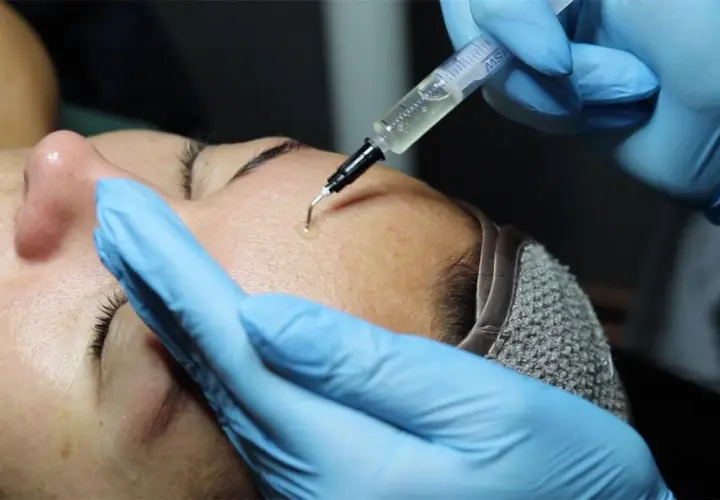 Close-up of a person receiving a PRX-T33 facial treatment with a syringe applying solution to the forehead.
