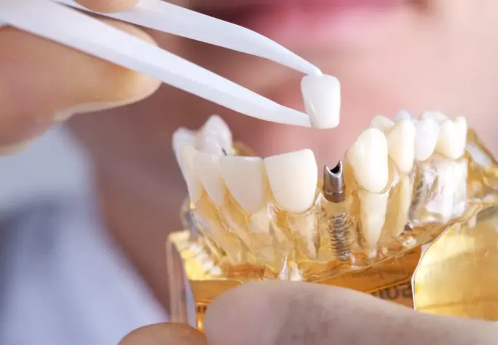 Modello di protesi dentale in zirconio, con pinzette che tengono una corona. Valutazione dei denti in zirconio: pro e contro.