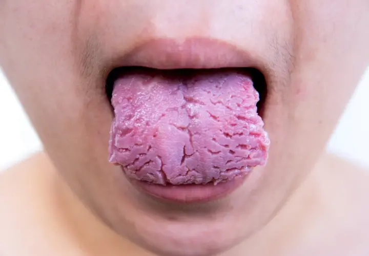 Lengua rosada con aspecto agrietado, como si tuviera una herida, sobresale de unos labios.