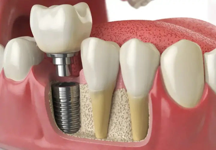 Immagine 3D di un impianto dentale inserito nell'osso, con una corona in cima. Si vedono anche denti naturali e gengive. Informazioni su innesto osseo dentale effetti collaterali.
