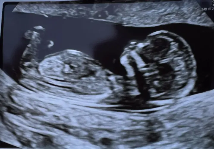Ecografia 14 settimane: profilo del feto, testa e corpo visibili. Si attende di scoprire se è maschio o femmina.