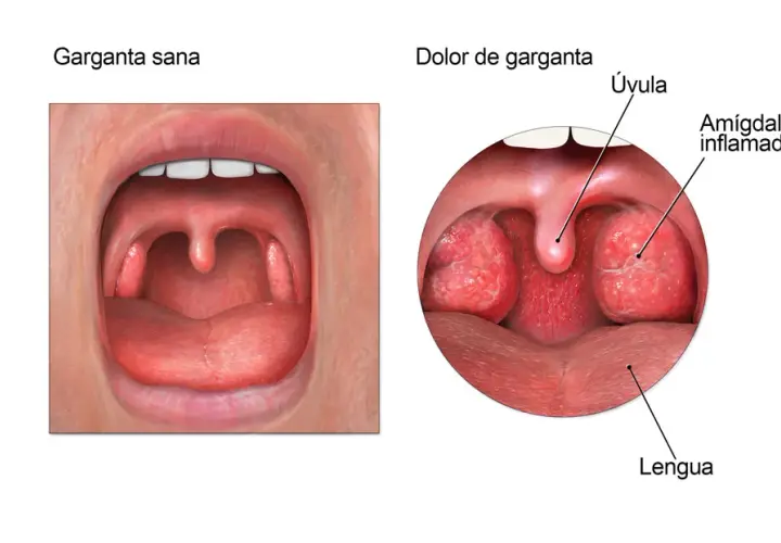 Medicamentos para el dolor de garganta: alivia el malestar rápidamente
