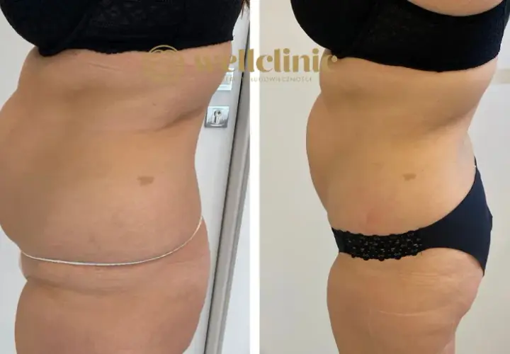 Liposukcja: Modelowanie sylwetki czy to rozwiązanie dla Ciebie?