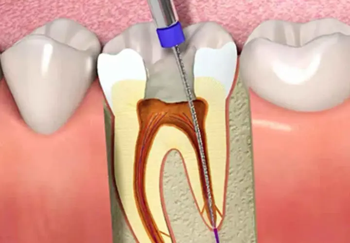 Procedimiento dental: un instrumento limpia el nervio de una muela al aire, mostrando el interior del diente.