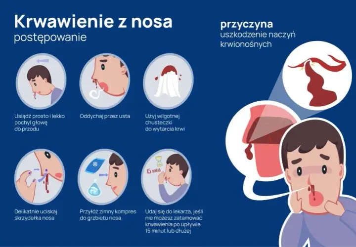 Krwawienie z nosa przyczyny: najczęstsze powody i co z nimi zrobić.