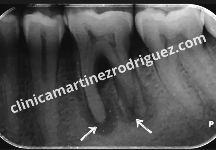 Radiografía dental muestra una posible infección endodoncia con áreas radiolúcidas en ápices radiculares, señaladas por flechas.