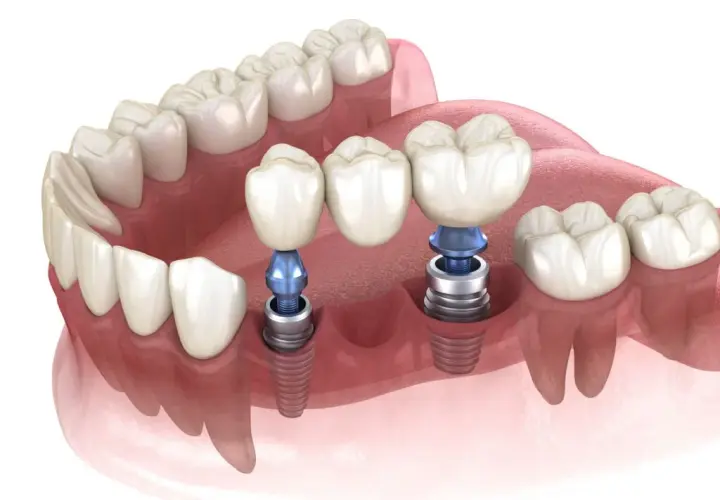 Koszt wstawienia zęba: Implant, most, proteza jak sfinansować?