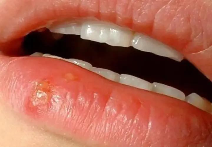 Labio con herpes, ampollas y costras. ¿Cuánto dura un herpes labial?