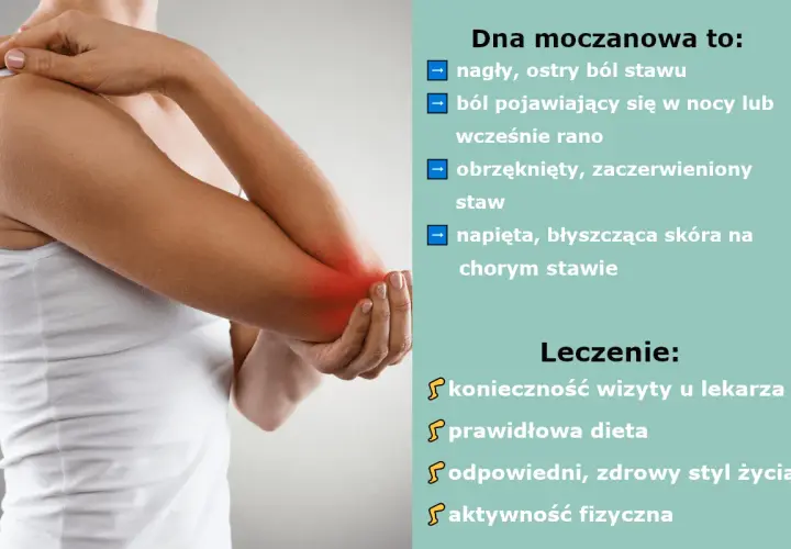 Dna moczanowa objawia się nagłym, ostrym bólem stawu, obrzękiem i zaczerwienieniem. Leczenie obejmuje wizytę u lekarza, dietę i zdrowy styl życia.
