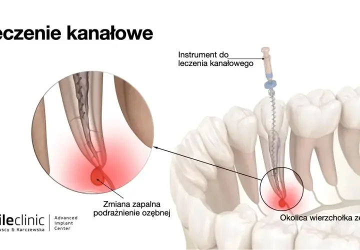 Leczenie kanałowe: Objawy, przyczyny i kiedy jest konieczne?