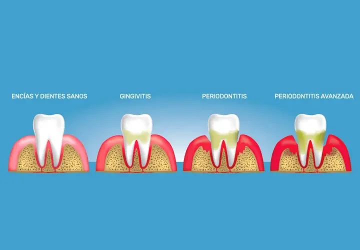 Ilustración muestra la progresión de la gingivitis a periodontitis, con encías y dientes sanos, gingivitis, periodontitis y periodontitis avanzada.