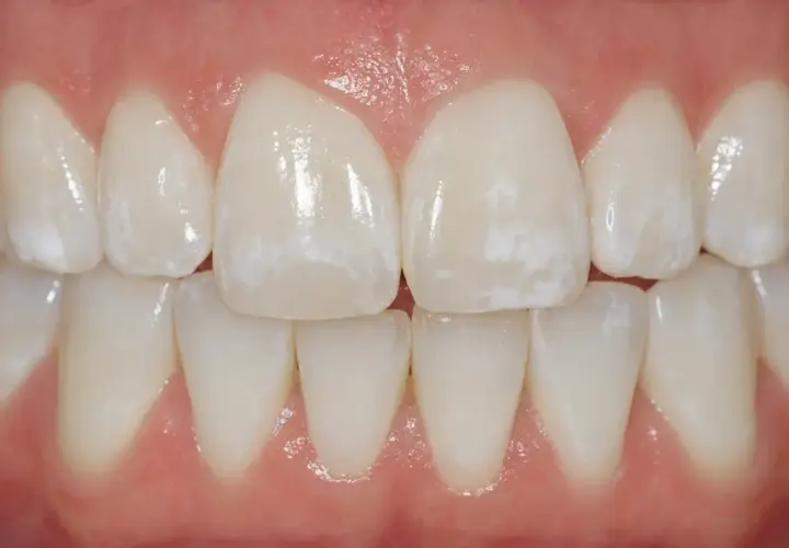 Denti con macchie bianche visibili, che potrebbero indicare problemi di smalto o ipomineralizzazione.