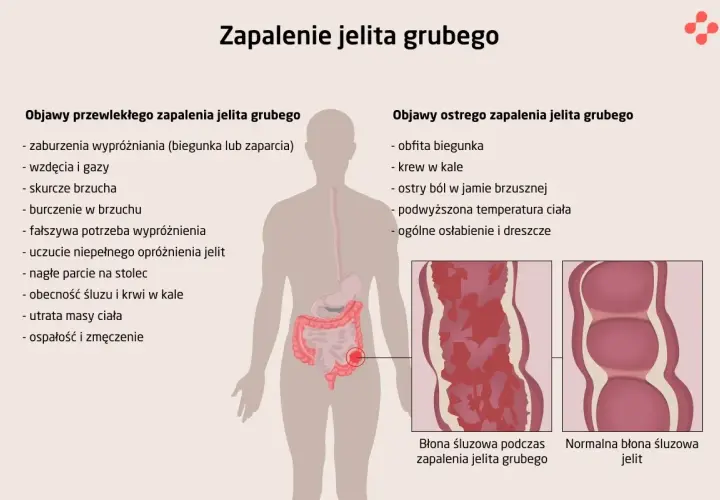 Ilustracja przedstawia objawy zapalenia jelita grubego, w tym bóle brzucha, biegunkę, krew w kale i osłabienie. Pokazuje też porównanie błony śluzowej jelita zdrowego i zmienionej zapalnie.
