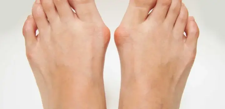 Od czego robią się haluksy? Genetyka, buty i nie tylko!