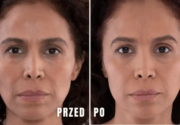 Przed i po zabiegu z użyciem kwasu polimlekowego pod oczy. Skóra wokół oczu jest gładsza, cienie zredukowane.