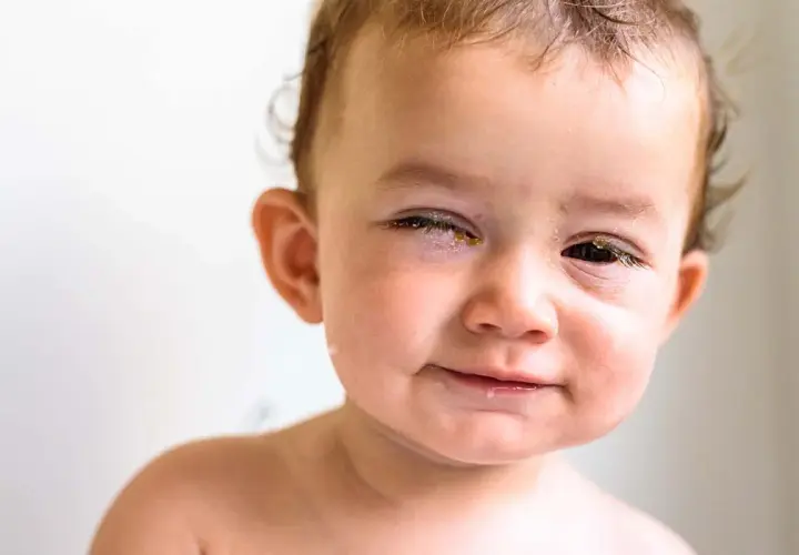 Ein Baby mit einem geschwollenen Augenlid einseitig. Gelbliche Verkrustungen am Auge. Hausmittel könnten helfen.