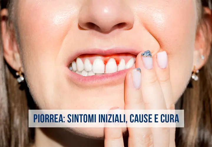 Gengive sanguinanti, un sintomo iniziale della piorrea. Scopri le cause e come curarla.