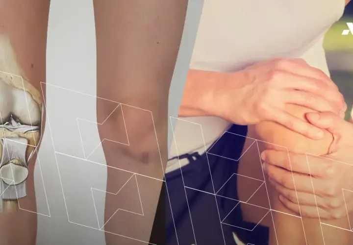 Anatomia kolana z widoczną rzepką i bólem odczuwanym przez osobę trzymającą się za kolano.