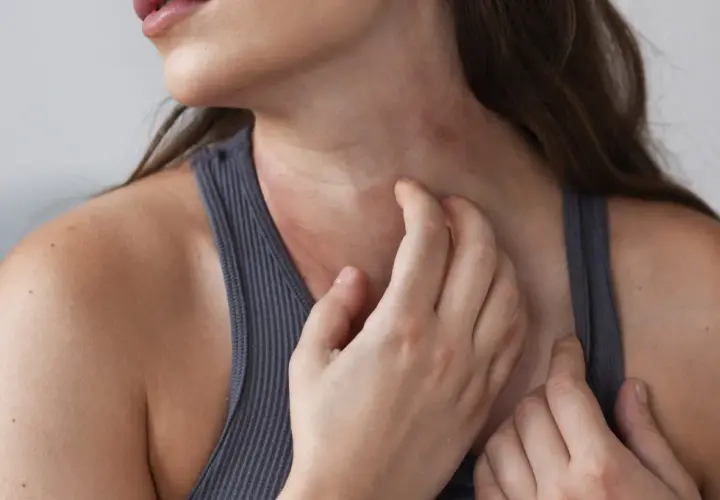 Una mujer se rasca el cuello, mostrando un sarpullido rojo e irritado.