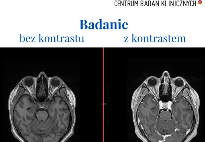 Skutki uboczne po podaniu kontrastu tomografii - co warto wiedzieć?