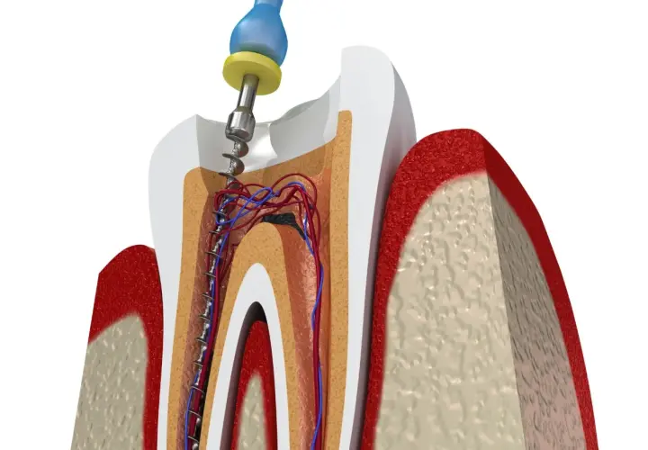 Instrumento dental limpia conducto radicular afectado por caries avanzada. Se aprecian vasos sanguíneos y nervios.