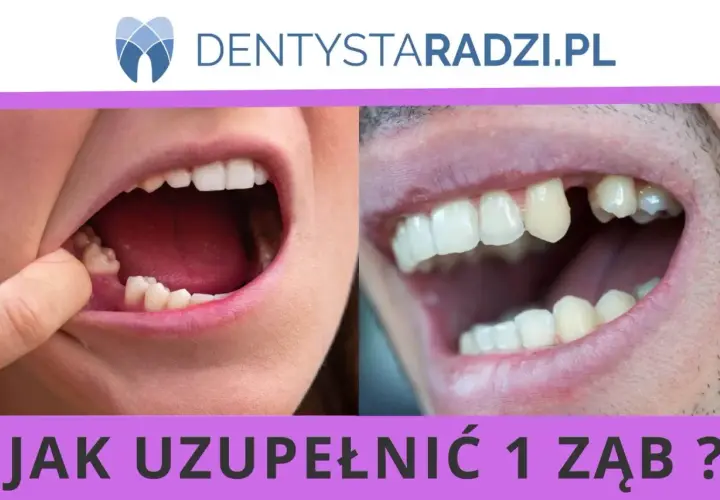 Usta z brakami zębowymi po lewej i prawej stronie. Widoczny problem z uzupełnieniem 1 zęba, który wymaga odbudowy.
