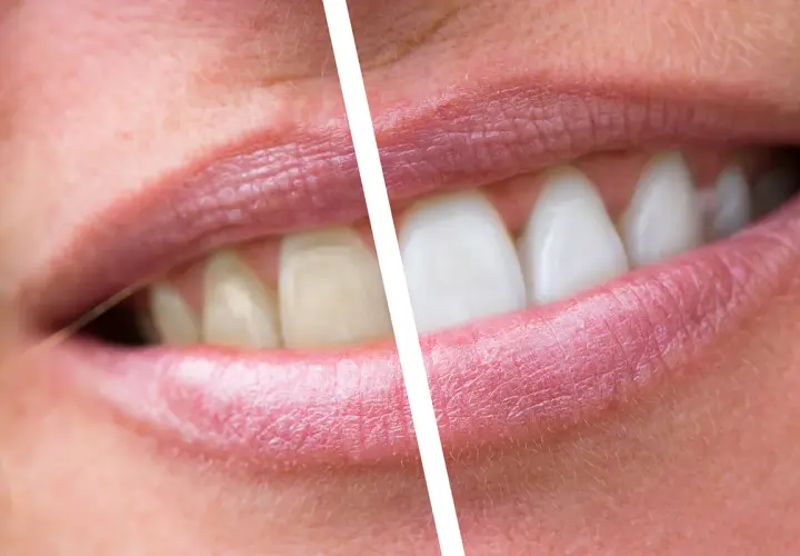 Prima e dopo: denti ingialliti e con placche, poi bianchi e splendenti. Un sorriso trasformato.