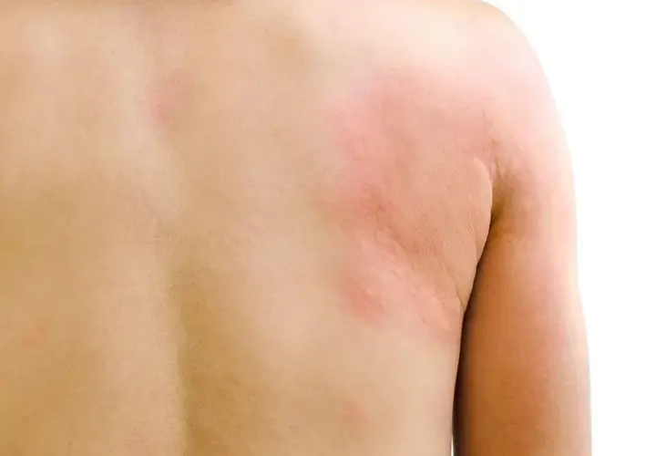 Objawy tocznia rumieniowatego: poznaj pierwsze niepokojące symptomy choroby