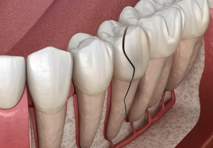 Dente con evidente crepe smalto, che si estende dalla corona alla radice, mostrando la vulnerabilità della struttura dentale.